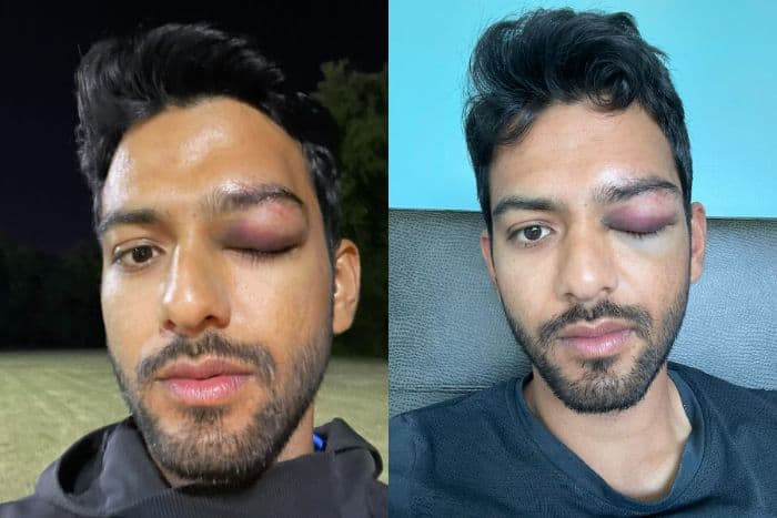 Unmukt Chand Suffers Serious Eye Injury; Says Grateful To Have Survived Possible Disaster